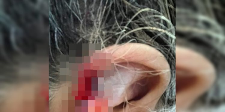 Neto arranca e engole pedaço da orelha da avó durante agressão