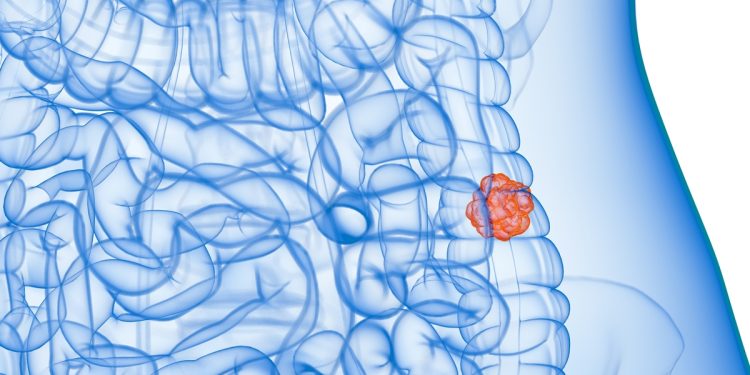 Conheça alteração silenciosa no intestino que pode evoluir para câncer