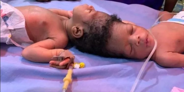 Gêmeas siamesas são separadas por cirurgia inovadora de 40 horas