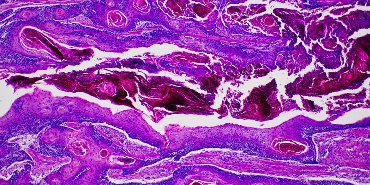 OMS alerta que novos casos de câncer podem quase duplicar até 2050