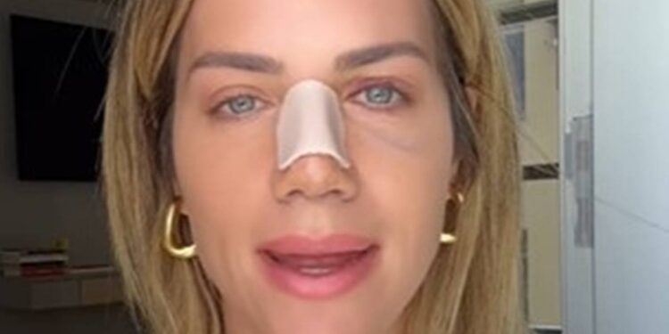 Desvio de septo: entenda a operação feita por Giovanna Ewbank