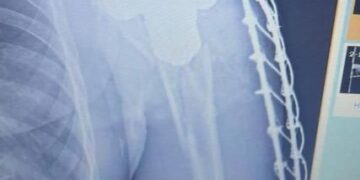 Médicos retiram haste de mina terrestre do corpo de soldado ucraniano. Fotos