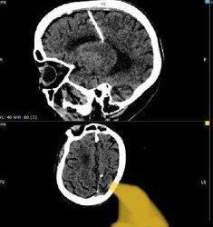 Ao realizar exames, idosa descobre agulha de 3 cm enfiada no cérebro