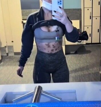 Mulher pega bactéria comedora de carne em injeção para queimar gordura