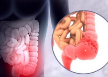 Câncer colorretal: o início do rastreio deve ser aos 45 ou 50 anos?