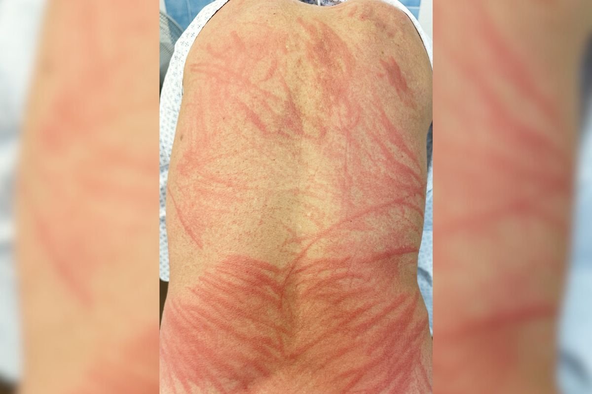 Dermatite de shitake: homem sente coceira intensa após comer cogumelos