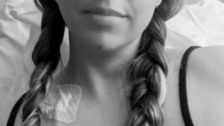 Mulher que atribuía manchas roxas à distração descobre ter anemia rara