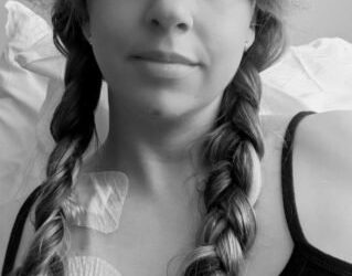 Mulher que atribuía manchas roxas à distração descobre ter anemia rara