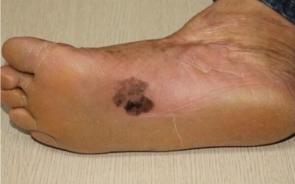 Melanoma acral: câncer de pele grave é mais comum no Norte do país
