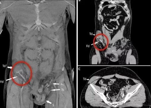 Homem sofre acidente de moto e seu testículo vai parar no abdômen