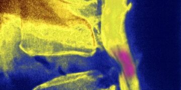 “Minhas crises de enxaqueca eram problema de coluna”, diz socióloga