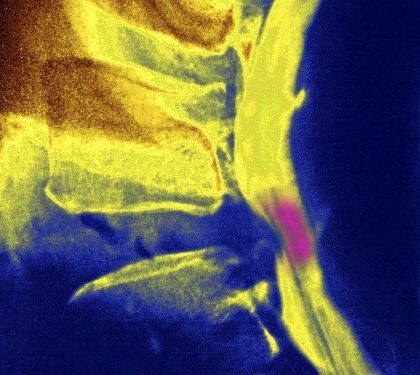 “Minhas crises de enxaqueca eram problema de coluna”, diz socióloga