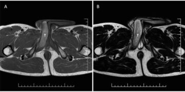 Homem passa 2 dias com ereções doloridas após treino para maratona
