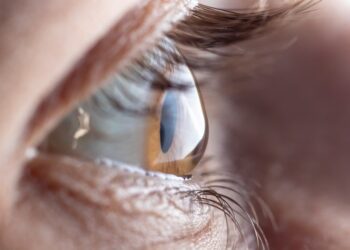Ceratocone: saiba o que é e como prevenir a doença
