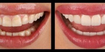 Erosão dentária: “Meu dente estava sensível até ao vento”, diz modelo