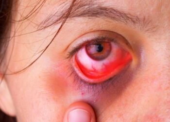 Herpes ocular: o que é, quais são os sintomas, qual o tratamento