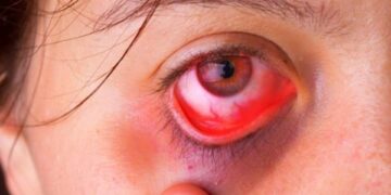 Herpes ocular: o que é, quais são os sintomas, qual o tratamento
