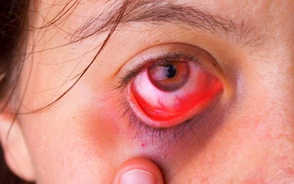 Herpes ocular: o que é, quais são os sintomas, qual o tratamento