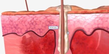 Doença grave de pele tem nova opção de tratamento aprovada pela Anvisa
