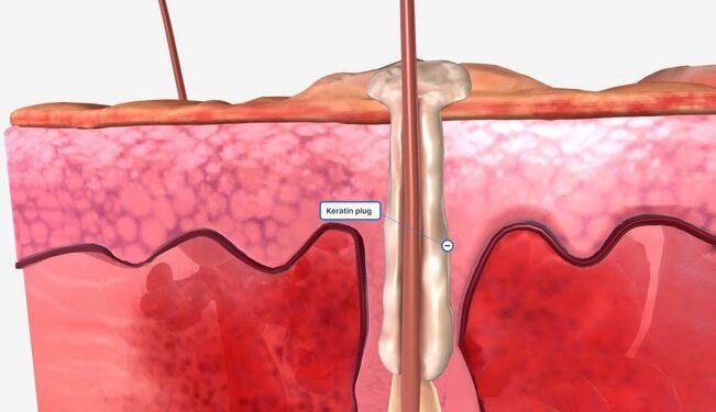 Doença grave de pele tem nova opção de tratamento aprovada pela Anvisa