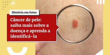 Vacina contra câncer de pele está prevista para 2025, diz Moderna