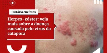 Herpes-zóster: conheça a doença que fez Damares Alves ser internada