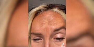 Método de bronzeamento causa manchas escuras em rosto de ex-miss