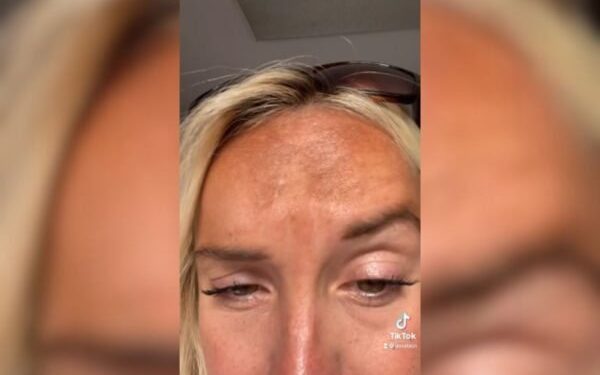 Método de bronzeamento causa manchas escuras em rosto de ex-miss