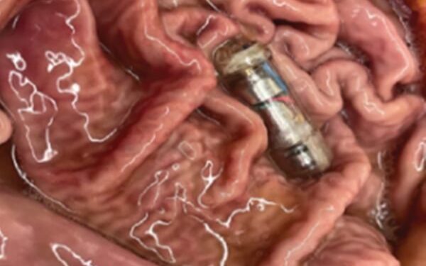 Pílula de Harvard aumenta saciedade e faz comer 40% menos, diz estudo