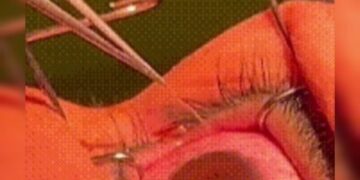 Médicos retiram 60 vermes dos olhos de mulher chinesa. Veja fotos