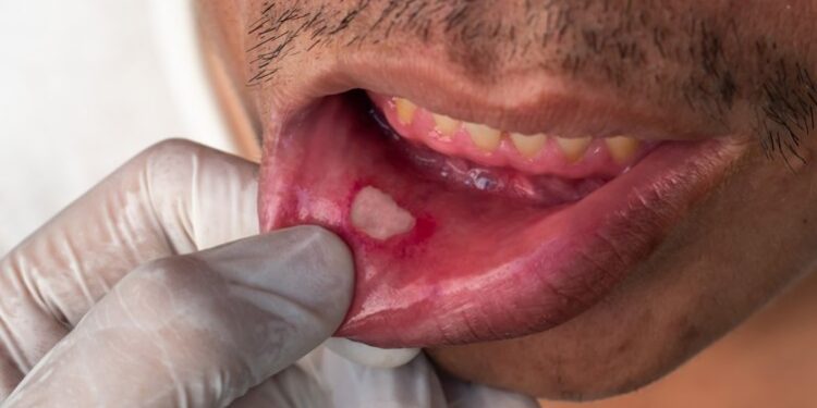 Rouquidão é um dos sinais precoces de câncer de boca. Veja lista