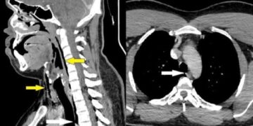 Homem coloca a vida em risco ao segurar espirro durante crise alérgica