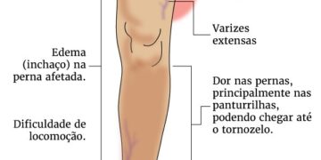 Trombose: ficar sentado tempo demais leva à doença? Saiba prevenir