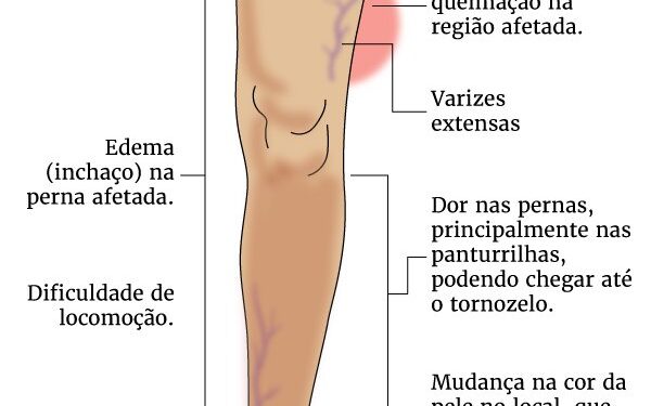 Trombose: ficar sentado tempo demais leva à doença? Saiba prevenir