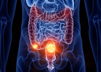 Câncer de intestino: saiba como é feita e quando começar a prevenção