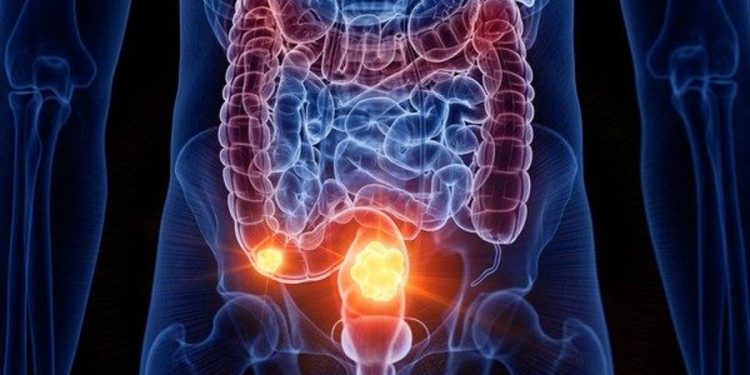 Câncer de intestino: saiba como é feita e quando começar a prevenção