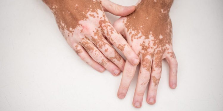 Vitiligo: entenda causas, sintomas e tratamento