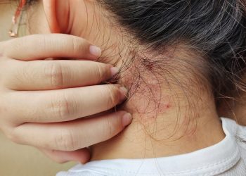 Alimentação pode influenciar sintomas da psoríase, aponta estudo