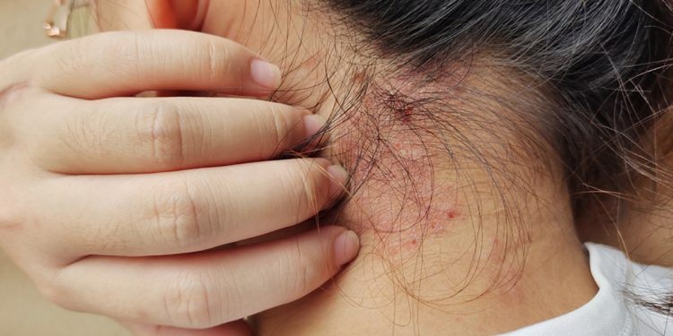 Alimentação pode influenciar sintomas da psoríase, aponta estudo