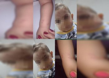 Mãe denúncia creche após filho chegar em casa com machucados. Veja