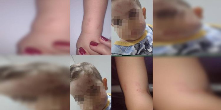 Mãe denúncia creche após filho chegar em casa com machucados. Veja