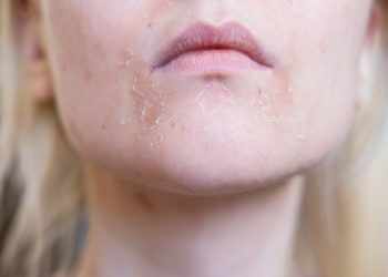 Pele descascando? Entenda causas e como evitar o problema no frio