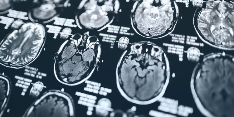 Idosa que apanhava de cuidadora no DF tem Alzheimer em grau avançado