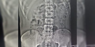 Bucho de erva: mecânico faz plano bizarro para traficar em prisão