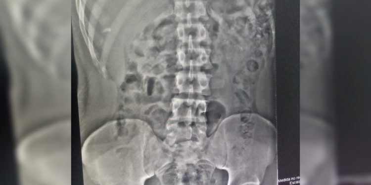 Bucho de erva: mecânico faz plano bizarro para traficar em prisão