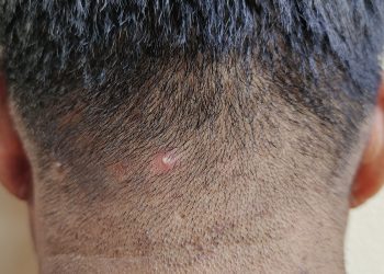 Acne no couro cabeludo: especialista explica como tratar a condição