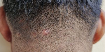 Acne no couro cabeludo: especialista explica como tratar a condição