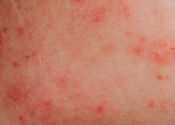 Alergia à água: condição real ou desculpa para não tomar banho?