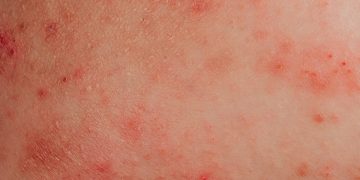 Alergia à água: condição real ou desculpa para não tomar banho?