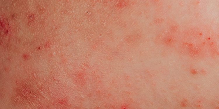 Alergia à água: condição real ou desculpa para não tomar banho?